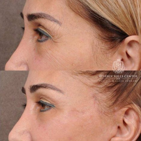 Beverly Hills Center Female Patient Before and After AuraLyft, Mini CUPID LIFT® Lip Lift, Upper Eyelids