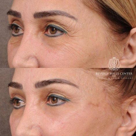 Beverly Hills Center Female Patient Before and After AuraLyft, Mini CUPID LIFT® Lip Lift, Upper Eyelids