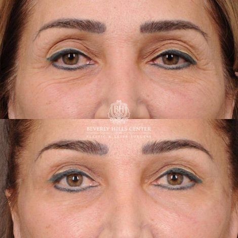 Beverly Hills Center Female Patient Before and After AuraLyft, Mini CUPID LIFT® Lip Lift, Upper Eyelids
