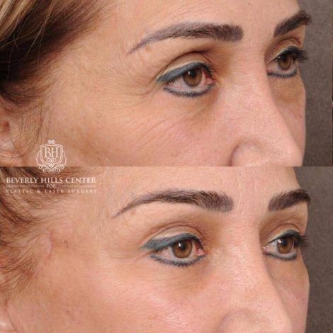 Beverly Hills Center Female Patient Before and After AuraLyft, Mini CUPID LIFT® Lip Lift, Upper Eyelids