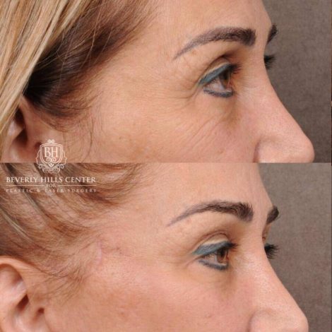 Beverly Hills Center Female Patient Before and After AuraLyft, Mini CUPID LIFT® Lip Lift, Upper Eyelids