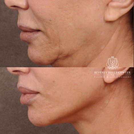 Beverly Hills Center Female Patient Before and After AuraLyft, Mini CUPID LIFT® Lip Lift, Upper Eyelids