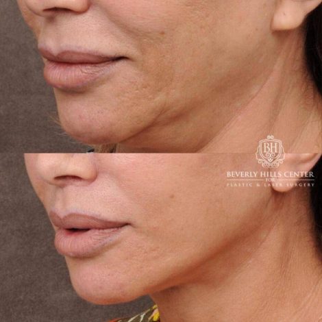 Beverly Hills Center Female Patient Before and After AuraLyft, Mini CUPID LIFT® Lip Lift, Upper Eyelids