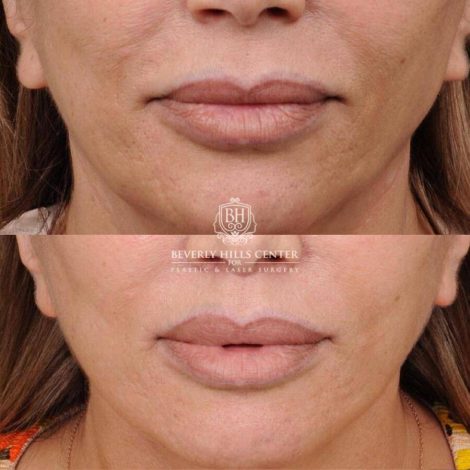 Beverly Hills Center Female Patient Before and After AuraLyft, Mini CUPID LIFT® Lip Lift, Upper Eyelids