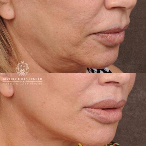 Beverly Hills Center Female Patient Before and After AuraLyft, Mini CUPID LIFT® Lip Lift, Upper Eyelids