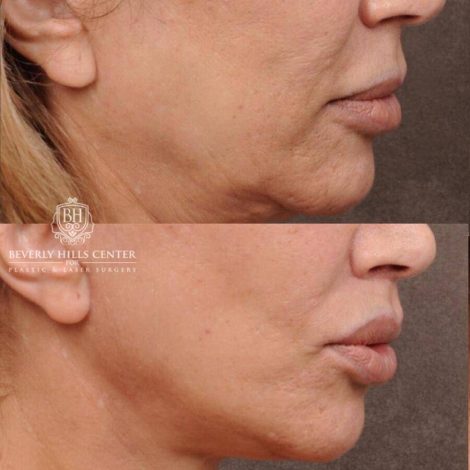 Beverly Hills Center Female Patient Before and After AuraLyft, Mini CUPID LIFT® Lip Lift, Upper Eyelids