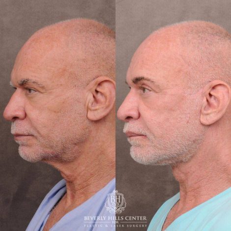 Beverly Hills Center Male Patient Before and After Comprehensive Auralyft