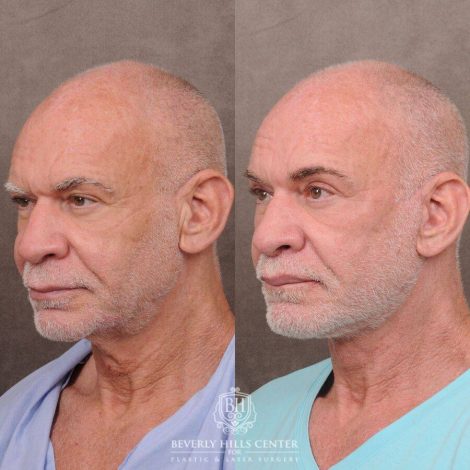 Beverly Hills Center Male Patient Before and After Comprehensive Auralyft