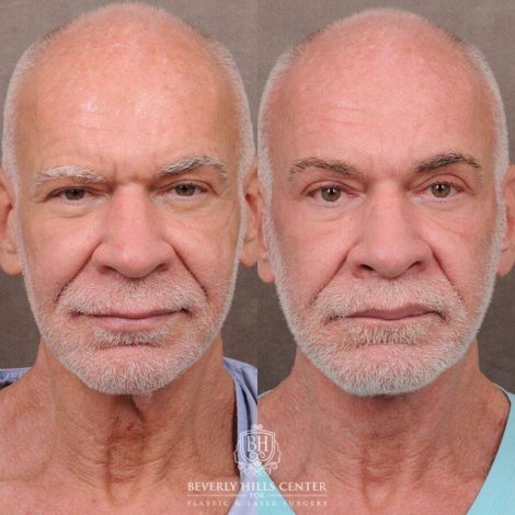 Beverly Hills Center Male Patient Before and After Comprehensive Auralyft