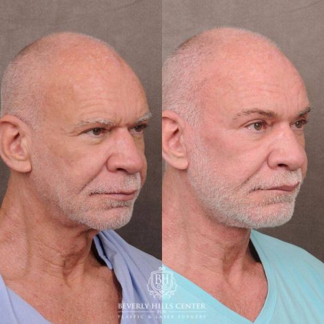 Beverly Hills Center Male Patient Before and After Comprehensive Auralyft