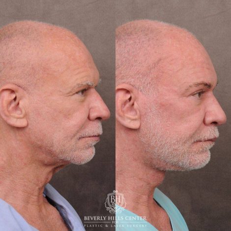 Beverly Hills Center Male Patient Before and After Comprehensive Auralyft