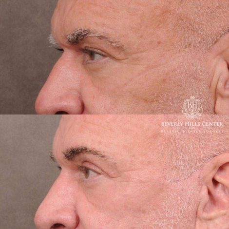 Beverly Hills Center Male Patient Before and After Comprehensive Auralyft