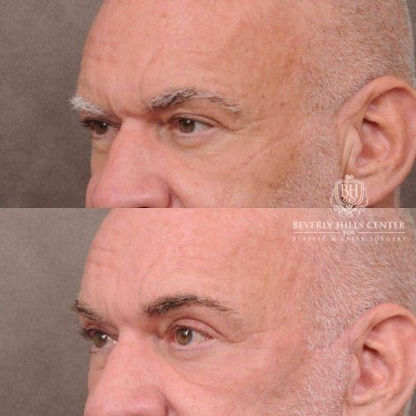 Beverly Hills Center Male Patient Before and After Comprehensive Auralyft
