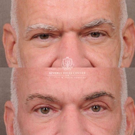 Beverly Hills Center Male Patient Before and After Comprehensive Auralyft