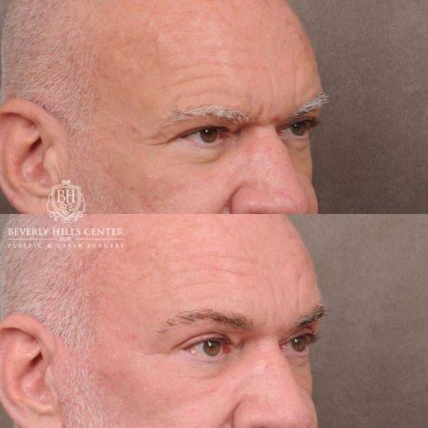 Beverly Hills Center Male Patient Before and After Comprehensive Auralyft