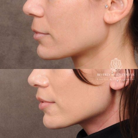 Beverly Hills Center Female Patient Before and After CUPID LIFT®