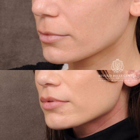 Beverly Hills Center Female Patient Before and After CUPID LIFT®