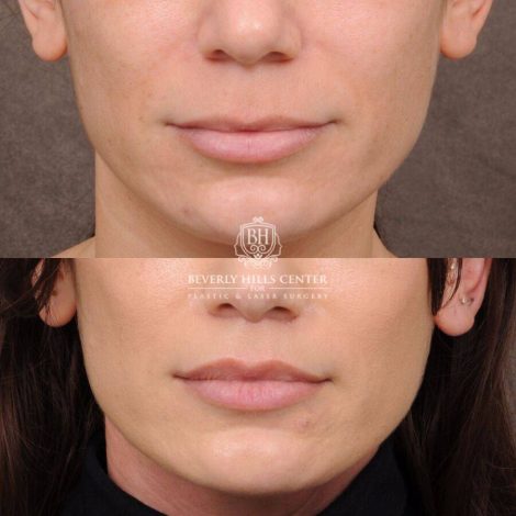 Beverly Hills Center Female Patient Before and After CUPID LIFT®