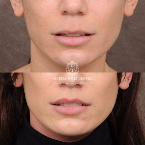 Beverly Hills Center Female Patient Before and After CUPID LIFT®