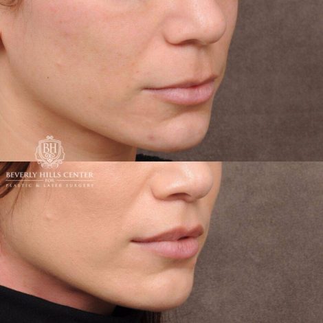 Beverly Hills Center Female Patient Before and After CUPID LIFT®