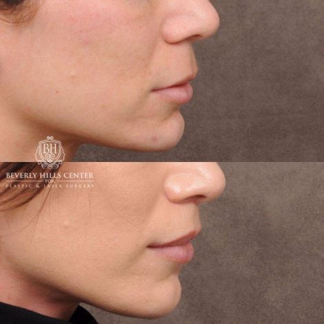 Beverly Hills Center Female Patient Before and After CUPID LIFT®