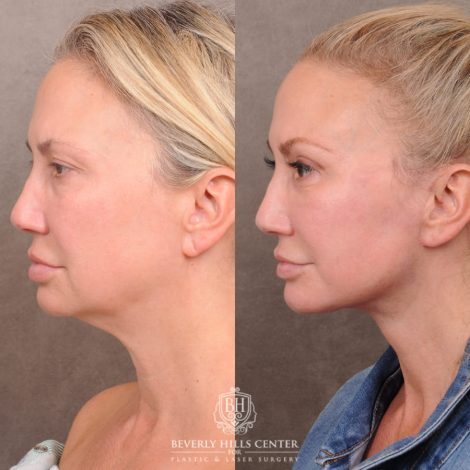 Beverly Hills Center Female Patient Before and After AuraLyft with Ptosis Repair, Upper Blepharoplasty and Internal Brow Pexy