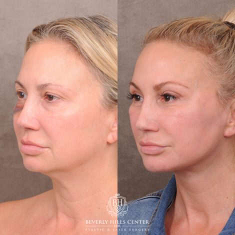 Beverly Hills Center Female Patient Before and After AuraLyft with Ptosis Repair, Upper Blepharoplasty and Internal Brow Pexy