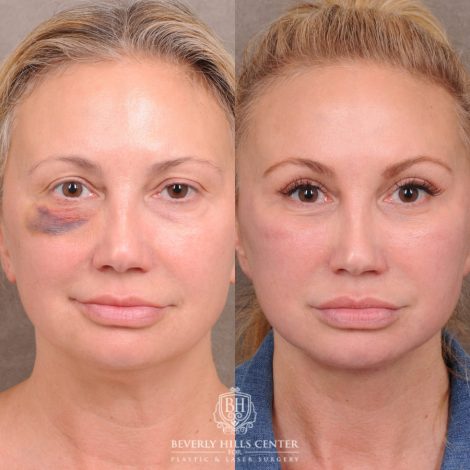 Beverly Hills Center Female Patient Before and After AuraLyft with Ptosis Repair, Upper Blepharoplasty and Internal Brow Pexy