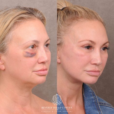 Beverly Hills Center Female Patient Before and After AuraLyft with Ptosis Repair, Upper Blepharoplasty and Internal Brow Pexy