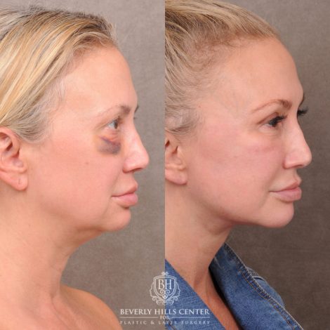 Beverly Hills Center Female Patient Before and After AuraLyft with Ptosis Repair, Upper Blepharoplasty and Internal Brow Pexy