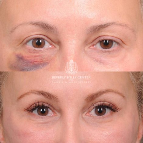 Beverly Hills Center Female Patient Before and After AuraLyft with Ptosis Repair, Upper Blepharoplasty and Internal Brow Pexy