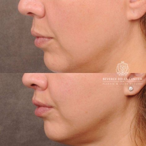 Beverly Hills Center Female Patient Before and After CUPID LIFT® Lip Lift