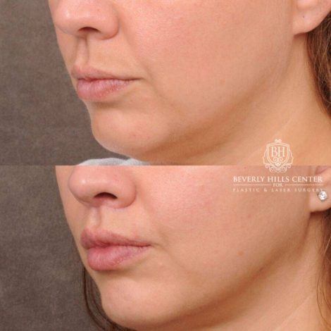 Beverly Hills Center Female Patient Before and After CUPID LIFT® Lip Lift