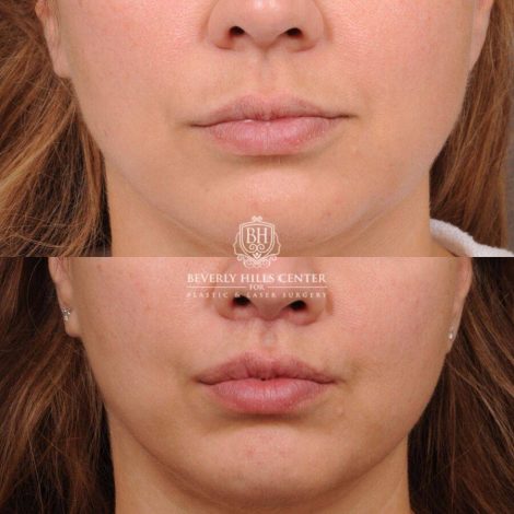 Beverly Hills Center Female Patient Before and After CUPID LIFT® Lip Lift