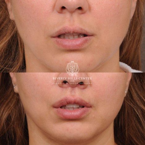 Beverly Hills Center Female Patient Before and After CUPID LIFT® Lip Lift