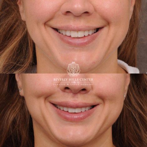 Beverly Hills Center Female Patient Before and After CUPID LIFT® Lip Lift