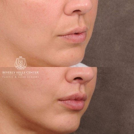 Beverly Hills Center Female Patient Before and After CUPID LIFT® Lip Lift