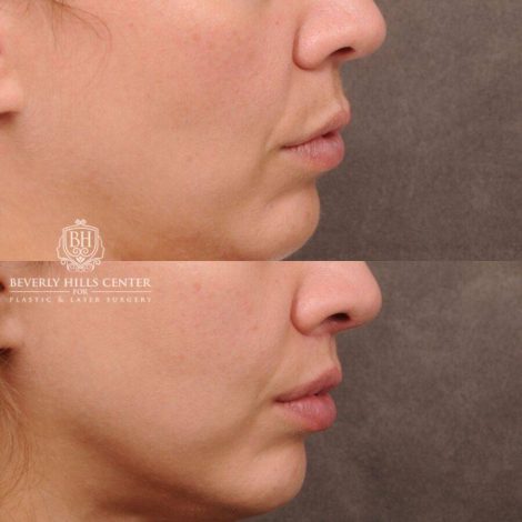Beverly Hills Center Female Patient Before and After CUPID LIFT® Lip Lift