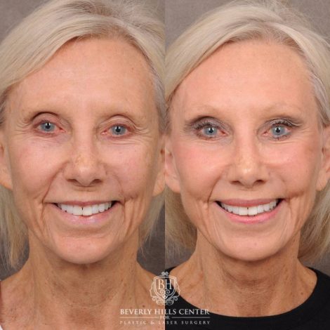 Beverly Hills Center Female Patient Before and After AuraLyft, Brow Lift, Lip Lift, UL Bleph, Ptosis