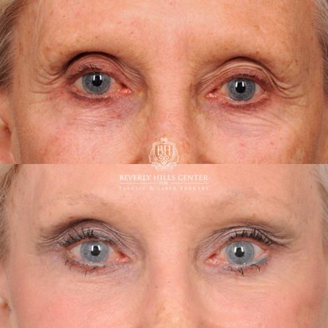 Beverly Hills Center Female Patient Before and After AuraLyft, Brow Lift, Lip Lift, UL Bleph, Ptosis
