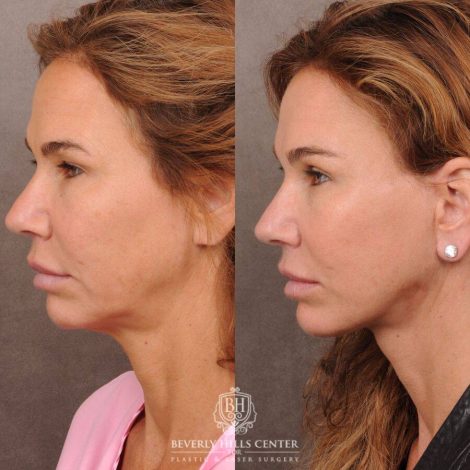 Beverly Hills Center Female Patient Before and After AuraLyft, Upper Blepharoplasty, Brow Lift, CUPID LIFT® Corner Lift