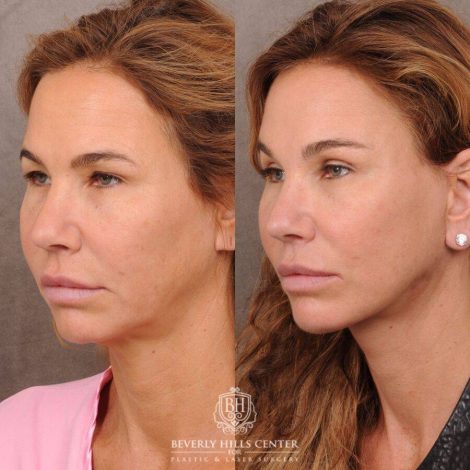Beverly Hills Center Female Patient Before and After AuraLyft, Upper Blepharoplasty, Brow Lift, CUPID LIFT® Corner Lift