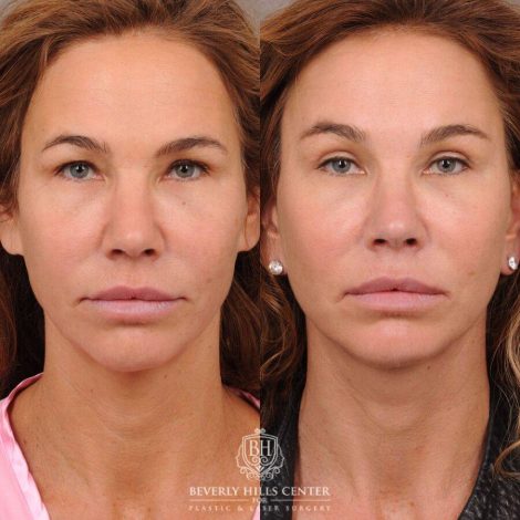Beverly Hills Center Female Patient Before and After AuraLyft, Upper Blepharoplasty, Brow Lift, CUPID LIFT® Corner Lift