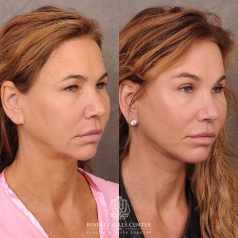 Beverly Hills Center Female Patient Before and After AuraLyft, Upper Blepharoplasty, Brow Lift, CUPID LIFT® Corner Lift