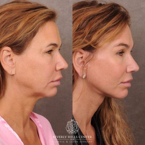 Beverly Hills Center Female Patient Before and After AuraLyft, Upper Blepharoplasty, Brow Lift, CUPID LIFT® Corner Lift