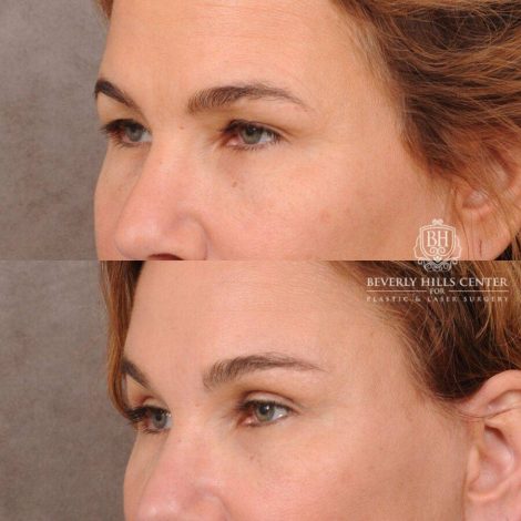 Beverly Hills Center Female Patient Before and After AuraLyft, Upper Blepharoplasty, Brow Lift, CUPID LIFT® Corner Lift