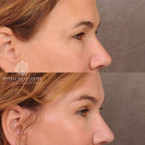 Beverly Hills Center Female Patient Before and After AuraLyft, Upper Blepharoplasty, Brow Lift, CUPID LIFT® Corner Lift