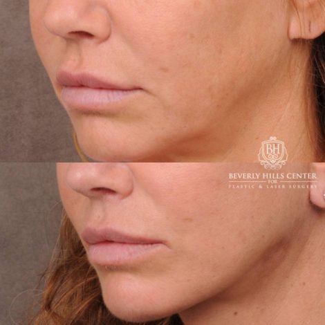 Beverly Hills Center Female Patient Before and After AuraLyft, Upper Blepharoplasty, Brow Lift, CUPID LIFT® Corner Lift