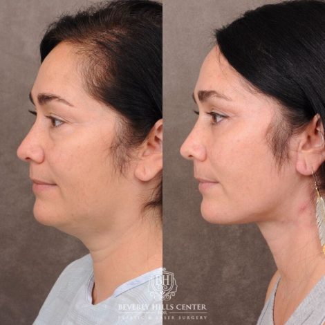 Beverly Hills Center Female Patient Before and After Weekend Necklift, Profound RF, Lower Eyelid Fat Repositioning