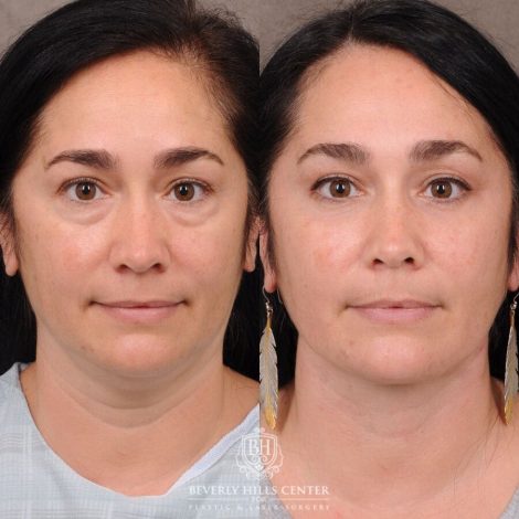 Beverly Hills Center Female Patient Before and After Weekend Necklift, Profound RF, Lower Eyelid Fat Repositioning
